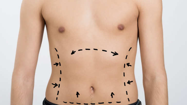 Liposuction Recovery in Charles County Maryland